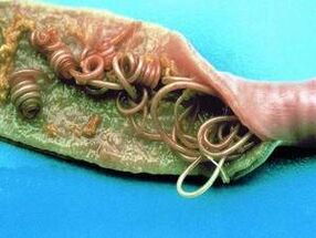 أسباب الطفيليات في جسم الإنسان