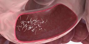 استخدام ثلاثة توائم لإزالة الطفيليات