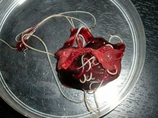 الديدان من جسم الإنسان